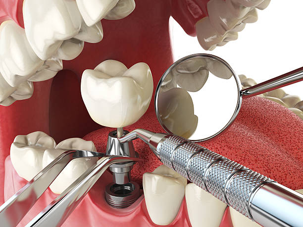 Best Emergency Dental Care for Broken or Chipped Teeth in Ferron, UT