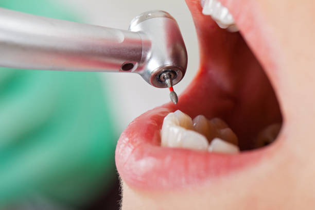 Best Urgent Care for Lost Fillings or Crowns in Ferron, UT
